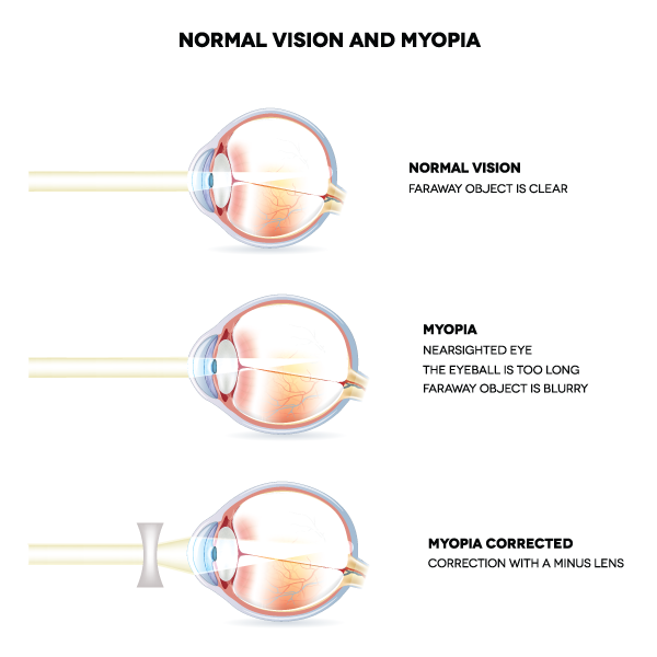 Eye Exam